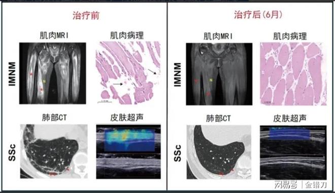120万天价药成过去式？上海团队立功细胞疗法仅10万：人人能用(图2)